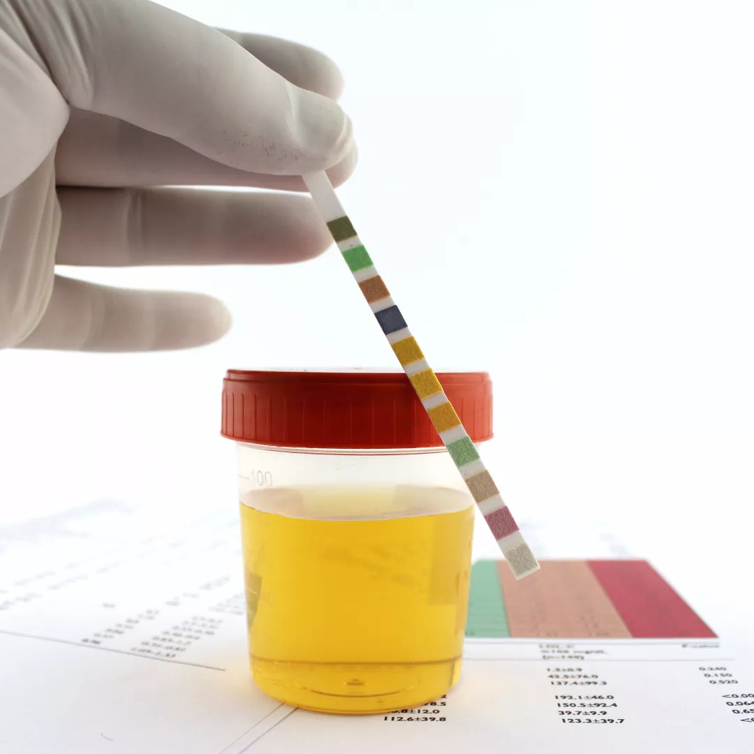 Urine Test Pathology S_M_ Hospital